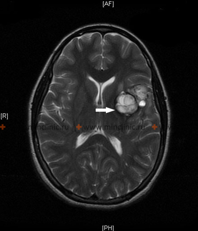 Magnetic resonance imaging of the brain (MRI) reveals arteriovenous malformations before rupture (white arrow).